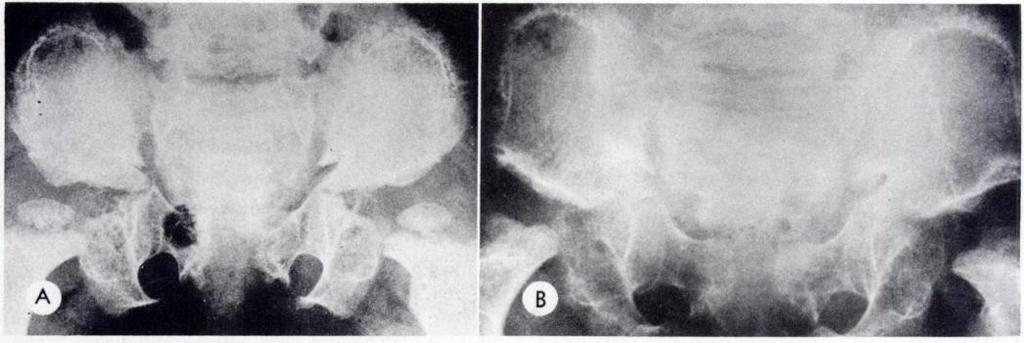110 SCHORR ET AL. TABLE 2 Differential Diagnosis Spinal Findings I..o;; i -.---- D M C Syndrome Fig. 6.-Pelvis and hip joints of patient S. A. Age 6.