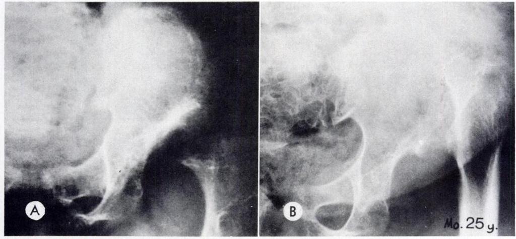. Morquio s Disease Spondyloepiphyseal Dysplasia Tarda Platyspondyly + + + + Vertebral hump Double - Posterior, - single, dense Spondylometaphyseal Dysplasia Hypoplasia of thonacolumban vertebrae.