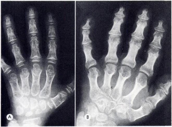 112 SCHORR ET AL. Fig. 10.-Hand of patient A., age 6. showing characteristic first metacarpal distal accessory ossifi cation centers, notched phalangeal ends. and coneshaped epiphyses.