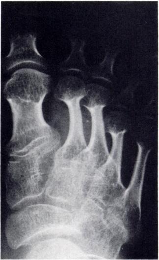 formation and kyphosis all clearly differentiate DMC syndrome from the Fig. 9.-Hand of patient S. A, Age 5. Small and irregular carpal bones with more severe involvement of proximal row.