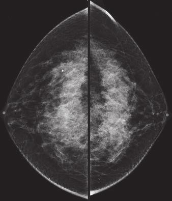 Breast Cancer Screening Ultrasound 18. Gordon PB, Goldenberg SL. Malignant breast phy.