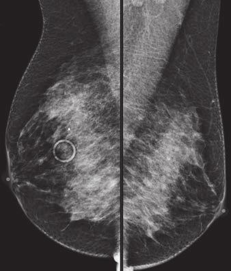 Detection of mammography with and without automated tive review. Cancer 1995; 76:626 630 breast cancer with addition of annual screening whole-breast ultrasound. Eur Radiol 2010; 19. Kaplan SS.