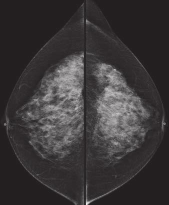 C, Cancer is seen on ultrasound. Pathologic analysis revealed ductal carcinoma in situ. A C B C Fig.