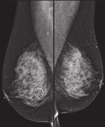 A, Craniocaudal mammographic views show normal BI-RADS density category 3 mammogram.