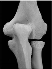flexion Shaft widens for medial and lateral support pillars Aids in