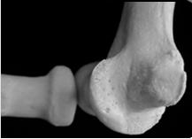 surfaces Trochlea medially articulates with the proximal ulna Capitulum