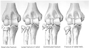 Medial Collateral Ligament Anterior band of the MCL most important for both valgus and