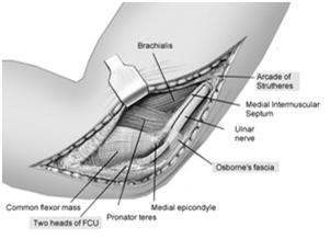 Floor of the cubital tunnel is the elbow capsule and MCL Roof is the fascia of the FCU and the arcuate ligament of Osborne (cubital retinaculum) The medial