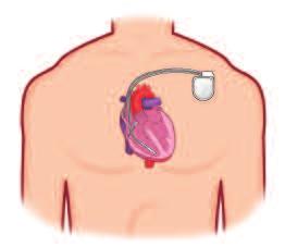 What is an ICD? An Implantable Cardioverter Defibrillator (ICD) is a small electrical device that monitors the rhythm of your heartbeat.