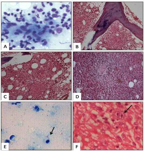 American Journal of Internal Medicine 2014; 2(5): 90-94 91 included marrow cellularity, location & morphology of the granulomas, fibrosis, caseous necrosis and inflammatory cells like plasma cells,