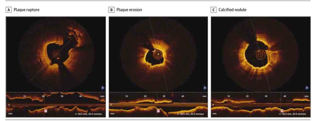 Representative Optical Coherence Tomography Images of Underlying Plaque Morphologies in