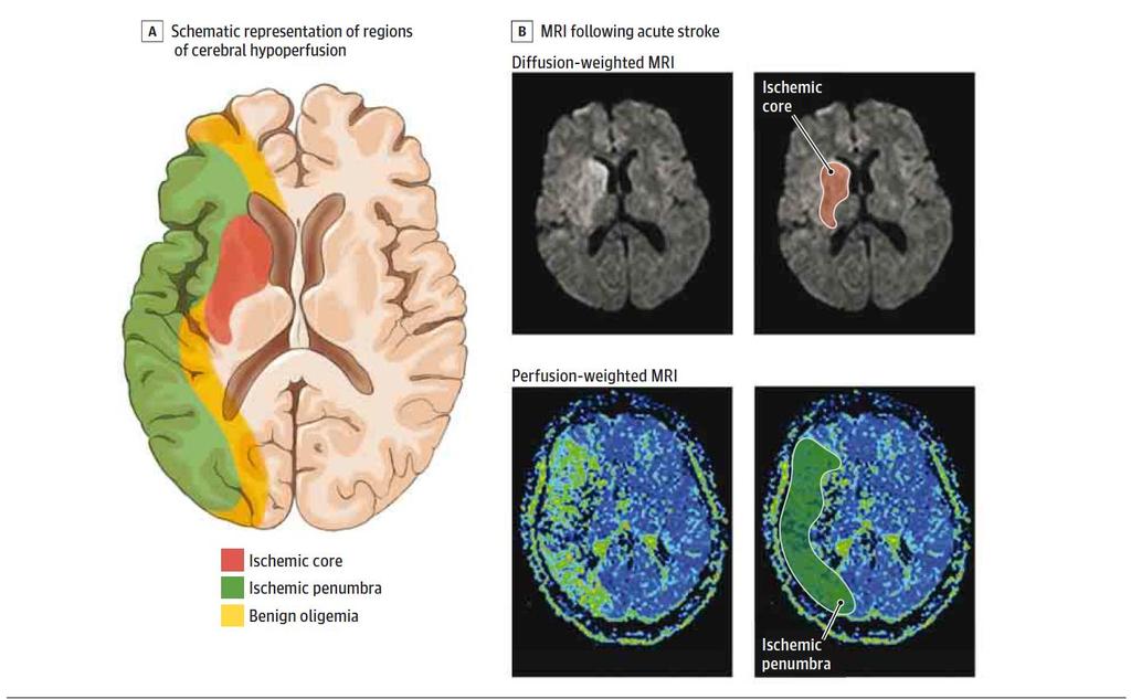 Regions of Cerebral Hypoperfusion Following