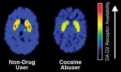 presence of extended release naltrexone (XR- NTX), for the treatment of cocaine dependence Participants are