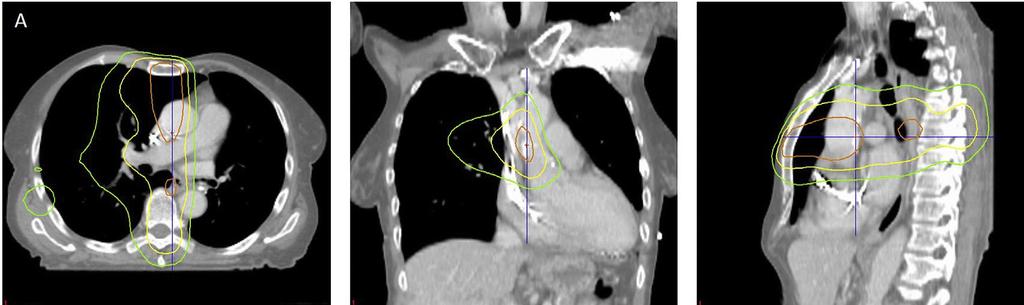 SURVIVAL VBA identified that the base of the heart is a dosesensitive region, strongly correlated with lung cancer patient survival.