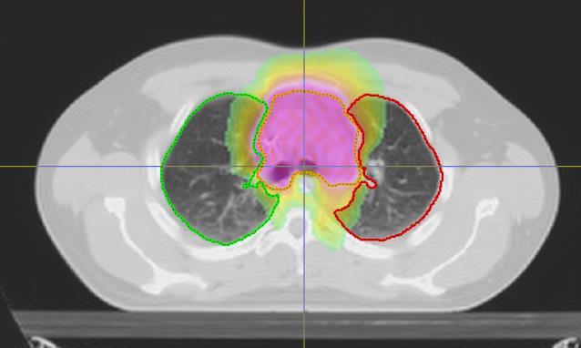 NTCP modelling Traditionally radiotherapy outcomes have been modelled using information about the dose distribution and the
