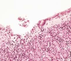 Anatomic Pathology / CASE REPORT Image 1 Collagenous gastritis involving gastric corpus mucosa (H&E, 50).