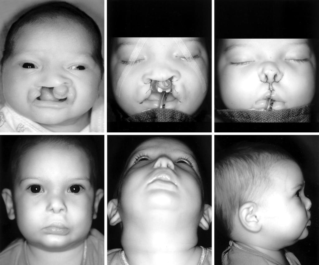Vol. 108, No. 1 / CLEFT LIP AND NASAL DEFORMITY 187 FIG. 3.(Above, left) Newborn with bilateral complete cleft lip/palate.
