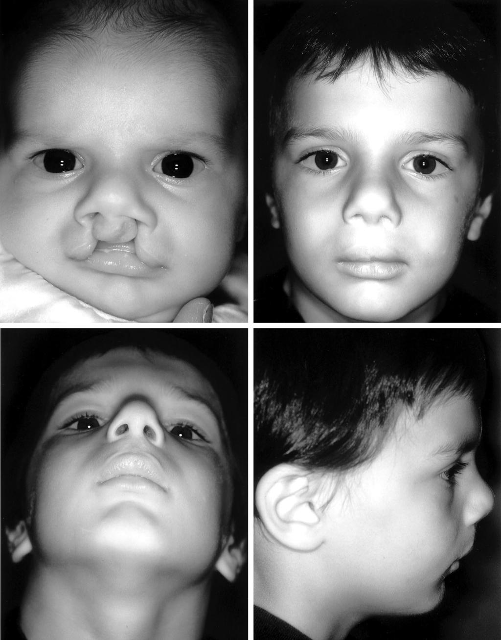 188 PLASTIC AND RECONSTRUCTIVE SURGERY, July 2001 FIG. 4.(Above, left) Newborn with bilateral cleft lip, right cutaneous band, and intact right alveolus and secondary palate.