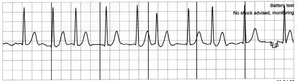 A 45 y/o woman with syncope A 77 y/o man with transient