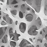 Osteoporosis Osteoporosis occurs when bones become thin and fragile.