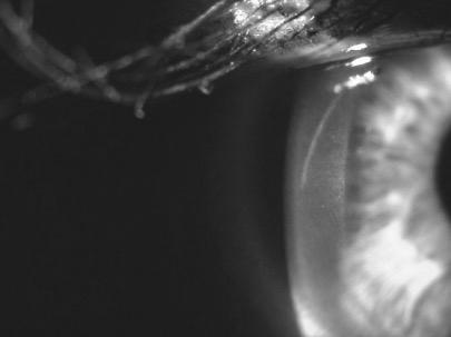 Refractive Considerations Astigmatism typically pre- op and post- op corneal astigmatism