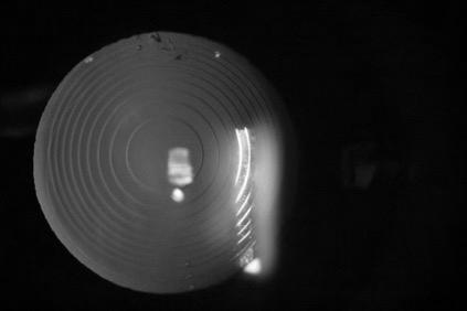 Tecnis Symfony Extended depth- of- focus lens (EDOF) Better near distances than monofocal, but not as well as well as multifocal