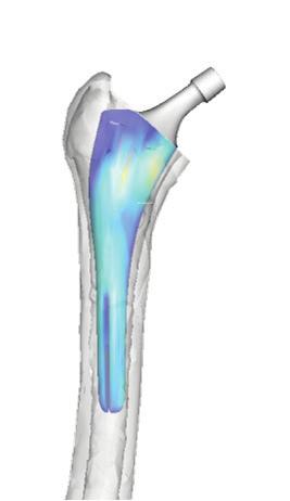 between the xz-plane and the original femoral neck axis.