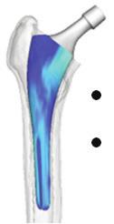3D surface models of femoral-stem implant design: M Automated planning: Maximize f( ; I) = g(r(i), A(L); ) Size : s