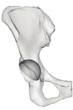 X-ray image of patient 3D pelvis shape