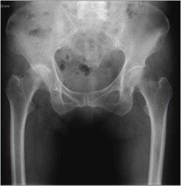Standard X-ray image of patient Extracted