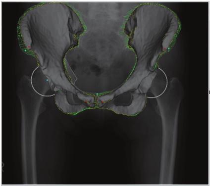 Fitting result of 3D pelvis SSM Automated