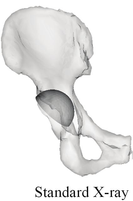 (a) and (b) show reconstruction errors on 3D pelvis surface.