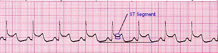 ST elevation is a sign of myocardial injury as seen in AMI. It may also indicate coronary vasospasm (Prinzmetal's angina), pericarditis, and ventricular aneurysm. 6.
