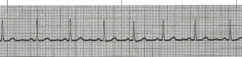NCH Paramedic Program Page 12 etc. Each small square represents a different HR value. Use this rate when more familiar with ECG interpretation. 6.