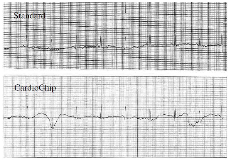 Testing the Accuracy of ECG Captured by through Comparison of ECG Recording to a Standard 12-Lead ECG Recording Device Data Analysis a) R-wave Comparison: The mean and standard deviation of R-wave