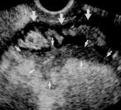 If only two signs were required for positive diagnosis, transabdominal sonography yielded a sensitivity of 76% and a specificity of 67%.