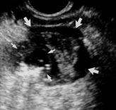 B, CT scan obtained immediately after reveals definite extension of mesocolic perforation (arrows). This determination is not possible with transrectal sonography.
