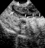 Different layers of the bowel wall (mucosa, submucosa, and muscularis propria) are regularly shown on high-resolution sonography.