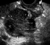 Transrectal Sonography of Sigmoid Diverticulitis TBLE 2 Sensitivity, Specificity, Predictive Values, and ccuracy of Transabdominal Sonography (TS) and Transrectal Sonography (TRS) in 46 Patients Who
