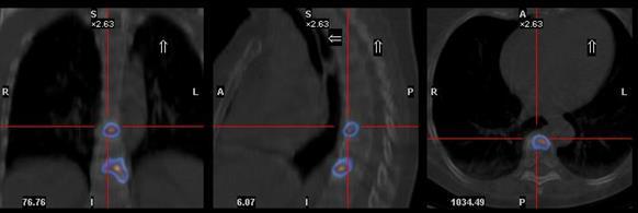 Bone Scintigraphy SPECT/CT against low specificity Complementary use of SPECT-CT can significantly improve the specificity of bone scintigraphy.