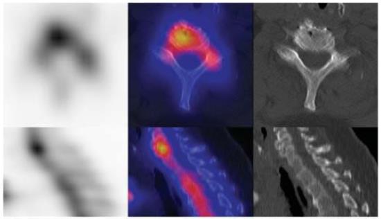 Bone Scintigraphy SPECT/CT against low specificity patient with breast cancer Osteochondrosis in C6/C7 Römer et al.