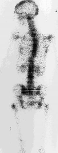 Bone PET 18 F-Fluorid A rectilinear 18 F-fluoride bone scan of a patientwith metastatic breast cancer performed in 1973 in