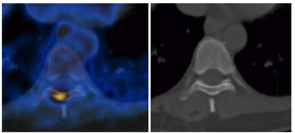 18 F-FDG PET Time of the imaging Most untreated bone metastases are PET positive and lytic on