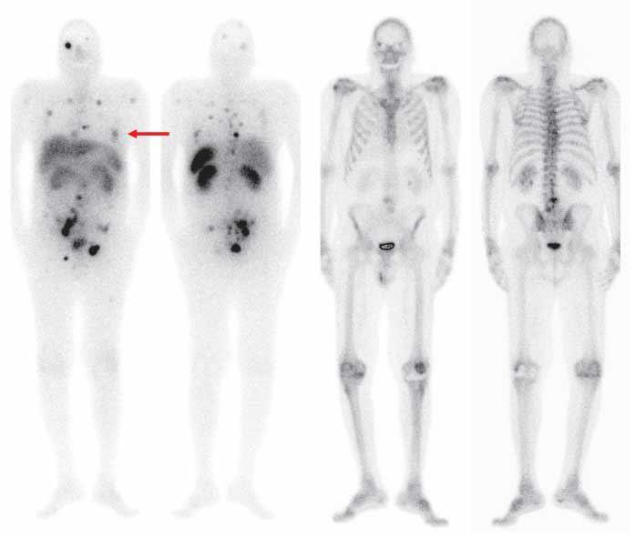 SSTR imaging vs bone scan Tumor specific imaging Comparison between bone scintigraphy and 177 Lu-DOTATATE-Imaging 29 patients with GEP-NET Bone scintigraphies was done within four weeks of initiation