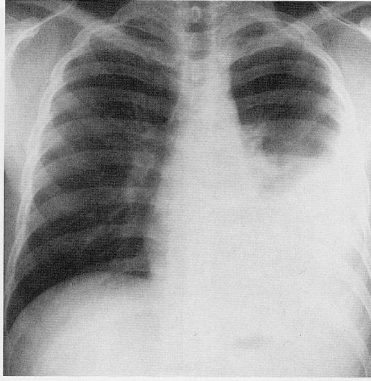 3) Pleural Effusion Usually late result of primary TB (3-7 months following exposure) Present in 10-40% cases in adults Nonspecific Most often