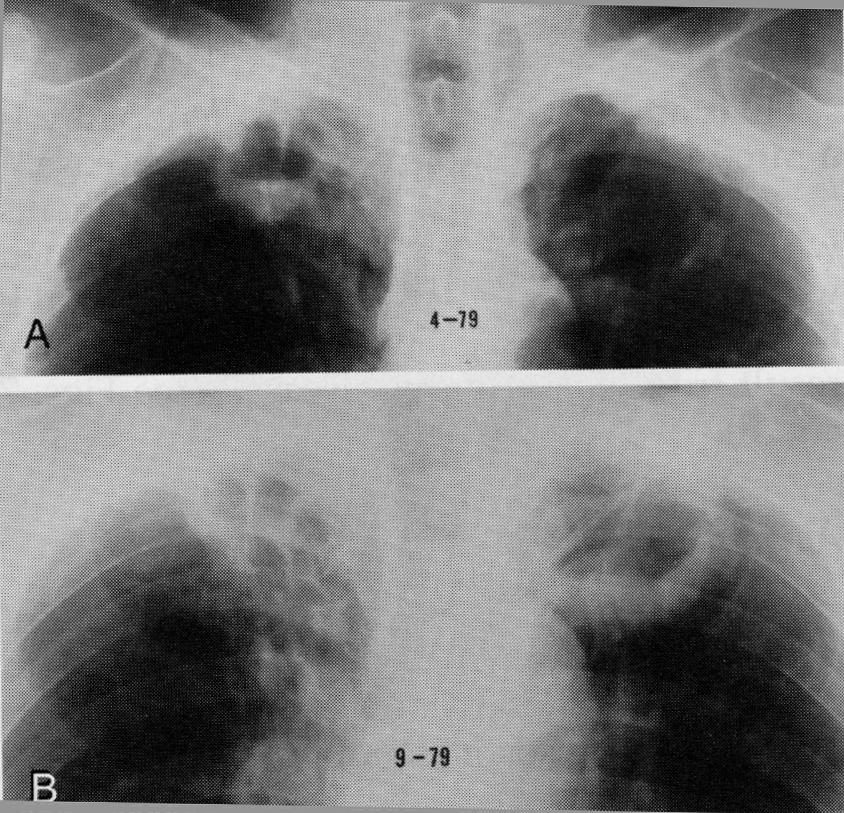 Post-primary TB: Cavitation Air-fluid level in cavity No specific findings to indicate tuberculous cavity Thin walled or thick