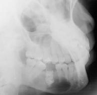 The central ray is directed toward the premolar-molar region from a point 2 cm below the opposite