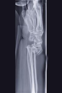 fracture and distal ulna