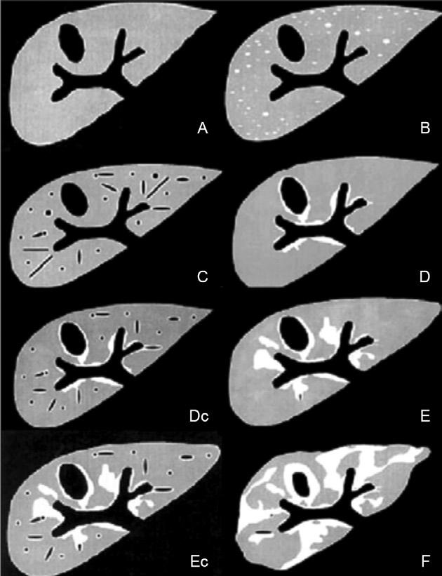 Mem Inst Oswaldo Cruz, Rio de Janeiro, Vol. 105(4), July 2010 483 Fig. 3: sonographic standardization of the liver in schistosomiasis mansoni.