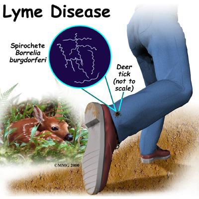 Introduction Lyme disease is an inflammatory disease caused by tick bites. It is the most common tick-borne disease in North America, Europe, and Asia.